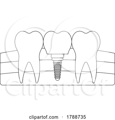 Black and White Tooth Implant by Lal Perera