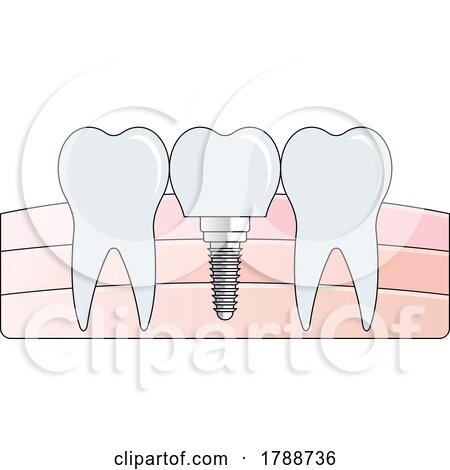 Tooth Implant and Gums by Lal Perera