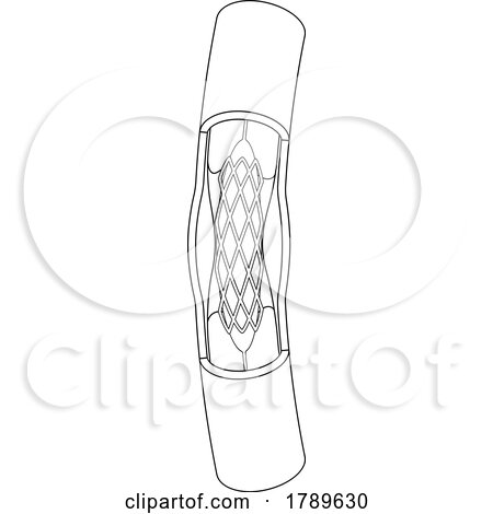 Black and White Medical Stent Procedure Diagram by Lal Perera