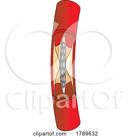 Medical Stent Procedure Diagram by Lal Perera