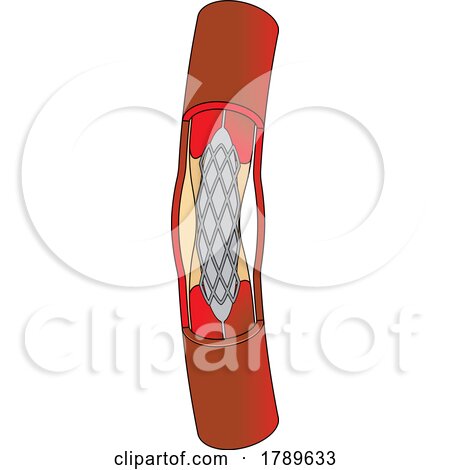 Medical Stent Procedure Diagram by Lal Perera