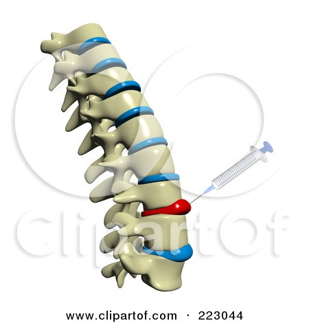 Royalty-Free (RF) Clipart Illustration of a 3d Spine With Deformed Spinal Discs And A Needle Injecting Medicine Into The Tissue by Michael Schmeling