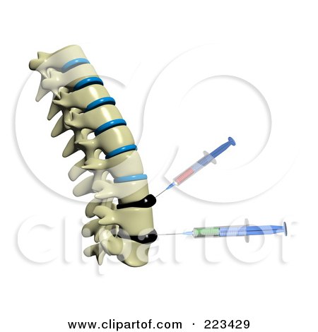 Royalty-Free (RF) Clipart Illustration of A 3d Spine With Deformed Spinal Discs And Needles Injecting Medicine Into The Tissue - 1 by Michael Schmeling