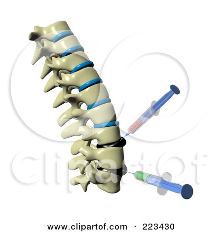 Royalty-Free (RF) Clipart Illustration of A 3d Spine With Deformed Spinal Discs And Needles Injecting Medicine Into The Tissue - 2 by Michael Schmeling