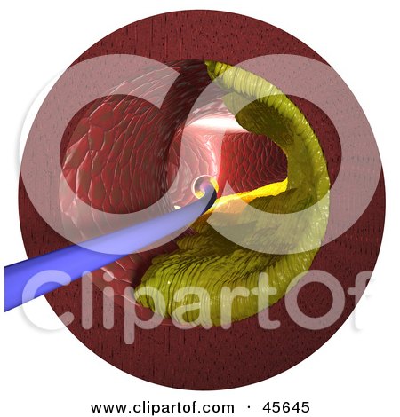 Royalty-free (RF) Clipart Illustration of a Scope Passing Through An Artery With Cholesterol Buildup Along The Wall by Michael Schmeling
