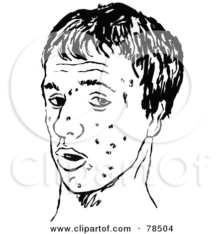 Royalty-Free (RF) Clipart Illustration of a Black And White Tenage Boy Face With Zits by Prawny