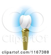 Clipart Of A Dental Tooth Implant Royalty Free Vector Illustration