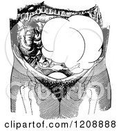 Clipart Of A Vintage Black And White Ovarian Tumor On The Left Side Of The Pelvis Royalty Free Vector Illustration