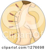 Clipart Of A Woman With Acupuncture Needles In Her Back Icon Royalty Free Vector Illustration
