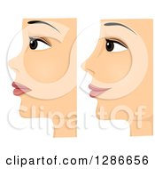 Poster, Art Print Of Composite Of Profiled Before And After On A Woman With Rhinoplasty Nose Surgery