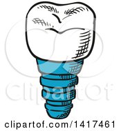 Clipart Of A Tooth Implant Royalty Free Vector Illustration