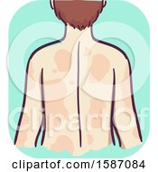 Clipart Of A Man Showing His Back And Breaking Out In Hives Royalty Free Vector Illustration