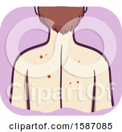 Clipart Of A Man With Red Mole Or Papule Growth On His Back Royalty Free Vector Illustration by BNP Design Studio