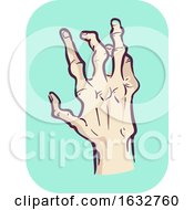 Hands Symptom Joint Deformity Illustration