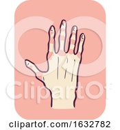 Poster, Art Print Of Hand Symptom Joint Redness Illustration