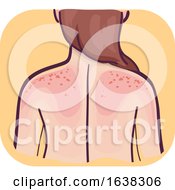 Poster, Art Print Of Back Symptoms Skin Sensitive Sunburn Illustration