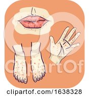 Symptoms Hand Feet Mouth Rashes Illustration
