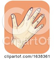 Poster, Art Print Of Hand Symptom Fragile Skin Illustration