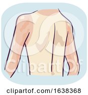 Poster, Art Print Of Back Symptom Reddish Undertone Skin Illustration
