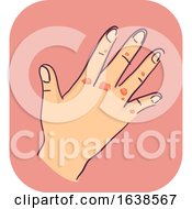 Hand Symptoms Scarred Illustration
