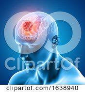Poster, Art Print Of 3d Medical Image Showing Male Figure With Brain Tumour
