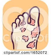 Foot Blisters Illustration
