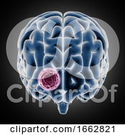 Poster, Art Print Of 3d Medical Image Showing Brain With Tumor Growing