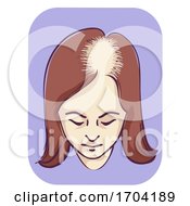 Poster, Art Print Of Girl Female Pattern Baldness Frontal Scalp
