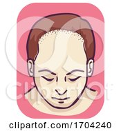 Poster, Art Print Of Male Pattern Baldness Frontal Hair Loss