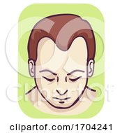 Poster, Art Print Of Man Pattern Baldness Hairline Loss Illustration