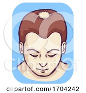 Poster, Art Print Of Man Pattern Baldness Hair Loss Vertex Illustration