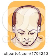 Poster, Art Print Of Man Pattern Baldness Top Hair Loss Illustration