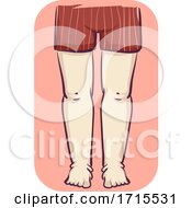 Poster, Art Print Of Girl Leg Swelling Illustration