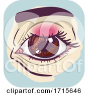 Poster, Art Print Of Symptom Eyes Chalazion Illustration
