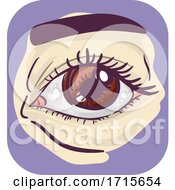 Poster, Art Print Of Symptom Eyes Bump Illustration