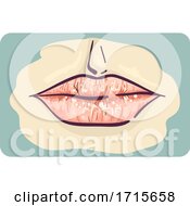 Poster, Art Print Of Symptom Dry Chapped Lips Illustration
