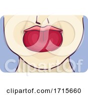 Poster, Art Print Of Symptom Swelling Tongue Illustration