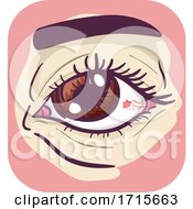 Symptom Red Spot On Eye Illustration