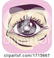 Poster, Art Print Of Symptoms Hazy Pupil Glaucoma Illustration