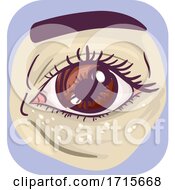 Symptoms Under Eye White Bump Skin Illustration