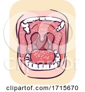 Poster, Art Print Of Symptoms Oral Thrush Illustration