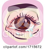 Poster, Art Print Of Symptoms Watery Itchy Dry Eyes Illustration