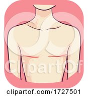 Poster, Art Print Of Breast Surgery Mastectomy Illustration
