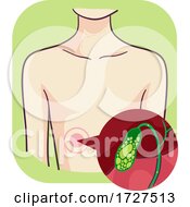 Poster, Art Print Of Symptoms Gallbladder Gallstones Illustration