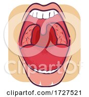 Poster, Art Print Of Symptom Mouth Tonsillitis Illustration