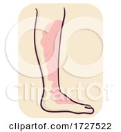 Poster, Art Print Of Symptom Leg Cellulitis Illustration