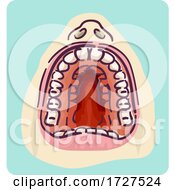 High Arched Palate Crowded Teeth Illustration