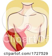 Heart Coronary Artery Bypass Plaque Illustration