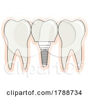 Poster, Art Print Of Tooth Implant