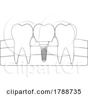 Poster, Art Print Of Black And White Tooth Implant